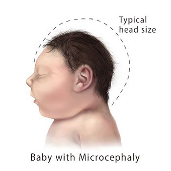 microcephaly